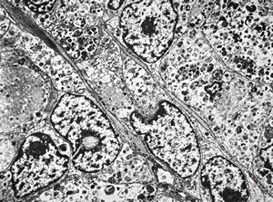 F,30y. | granular cell tumor